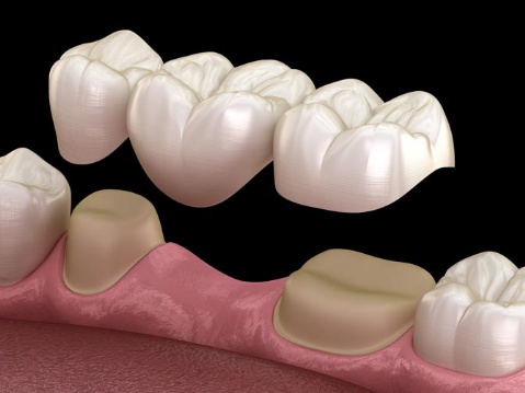 Periodoncia